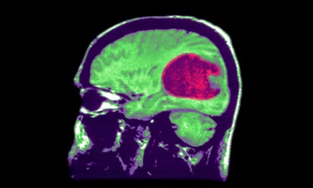 Ứng dụng trí tuệ nhân tạo vào điều trị u não